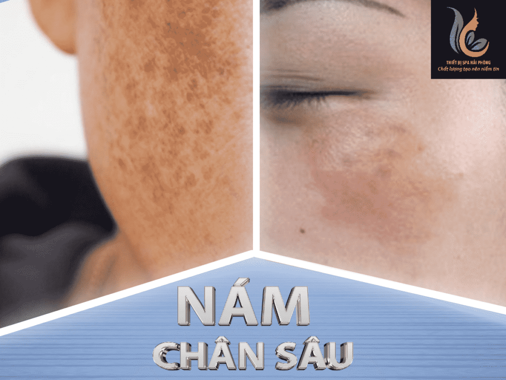 ban giao cong nghe dieu tri nam chuyen sau hai phong 1 1024x768 - Chuyển giao công nghệ laser trị nám chân sâu tại Hải Phòng