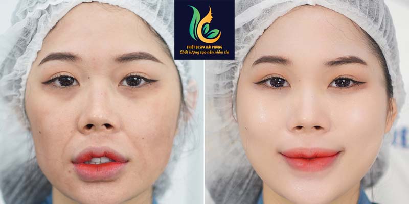 May RF nang co xoa nep nhan vung khoe mieng hai phong 4 - Máy RF nâng cơ xóa nếp nhăn vùng mắt khóe miệng tại Hải Phòng